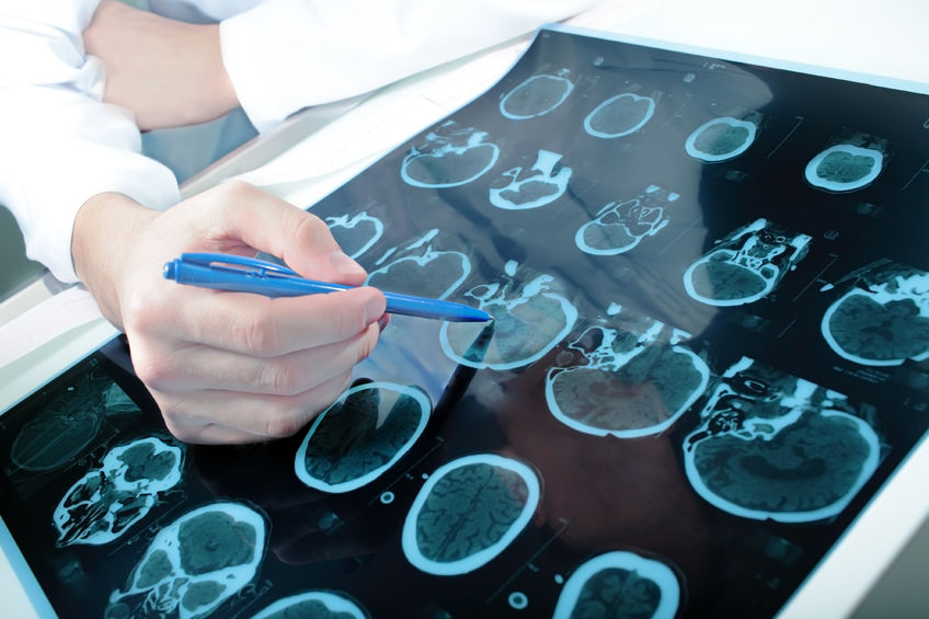 Parkinson’s Disease - Naturopathic Approaches